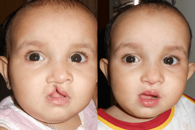 Cleft Surgeries