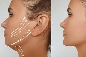 Chin Surgery (Genioplasty)
