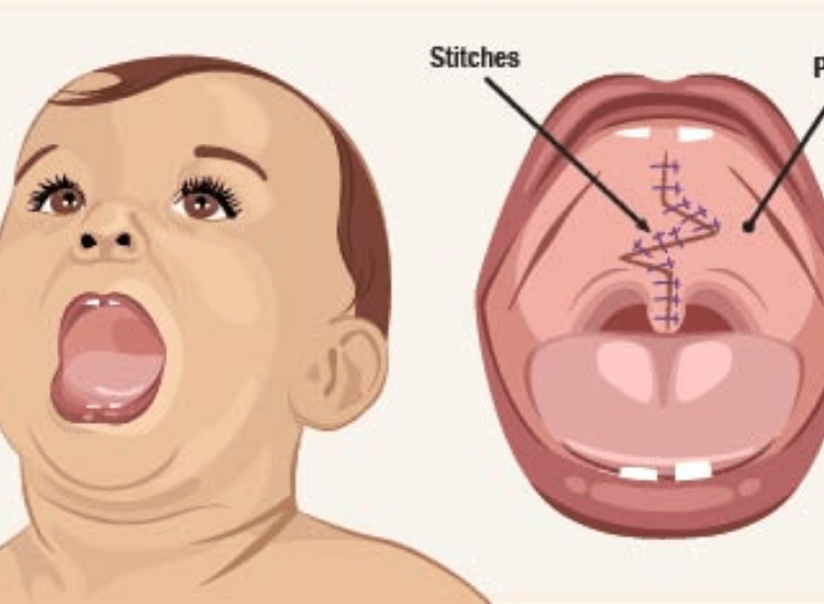 Best-Cleft-Surgeries-in-Mumbai-dr-Tofiq-bohra-2-min