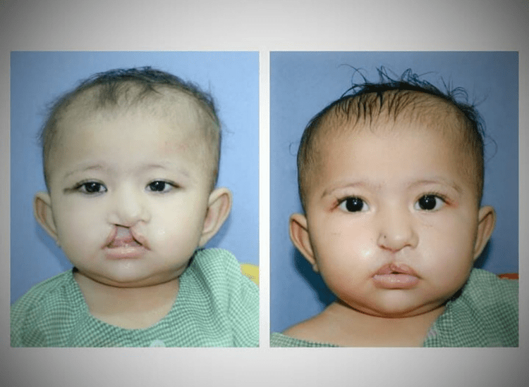 Best-Cleft-Surgeries-in-Mumbai-dr-Tofiq-bohra-min
